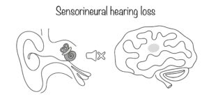 sensorineural hearing loss